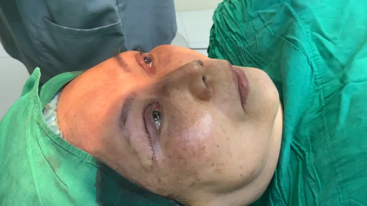 Kết quả cắt mí trên, loại da chùng, mỡ bọng cho cô khách đến từ VĨnh Long với Dr Vương !